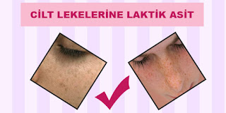 cilt lekelerine laktik asit cilt lekeleri geçirme laktik asit