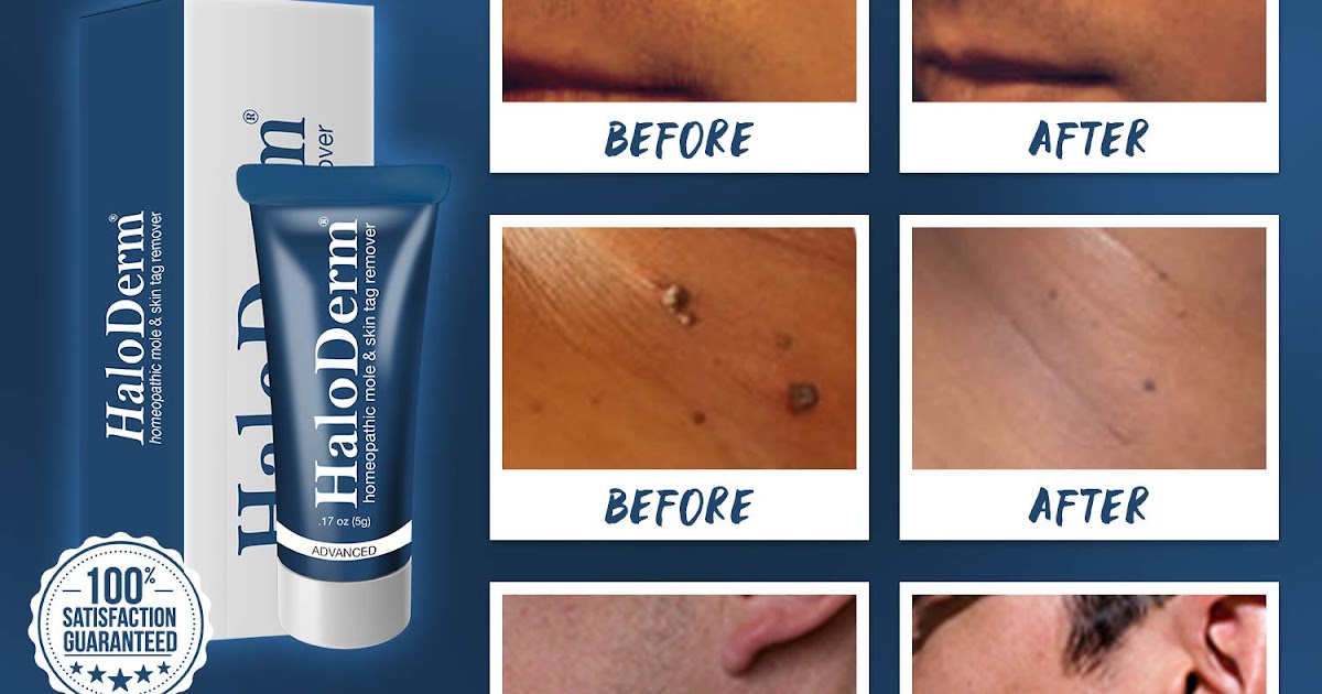 haloderm skin tag remover
