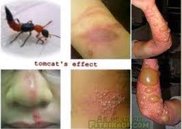 Charlie Insect Rash I'M A BBA STUDENT: CHARLIE