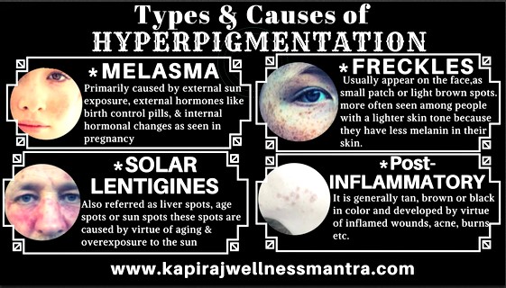 Types and Causes of Hyper-pigmentation