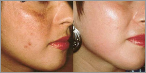 comment traiter les cicatrices d'acné naturellement