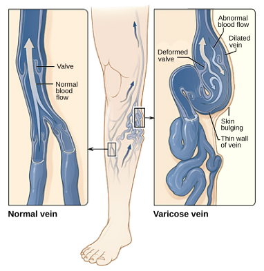 what is vein thrombosis