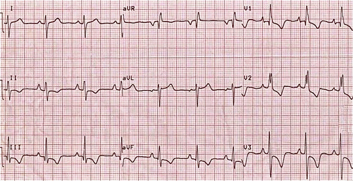 Right Ventricular Hyperthrophy | INA - ECG