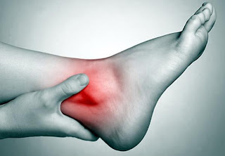 Pengobatan Paling Efektif Atasi Kaki Keseleo/Terkilir Secara Optimal
