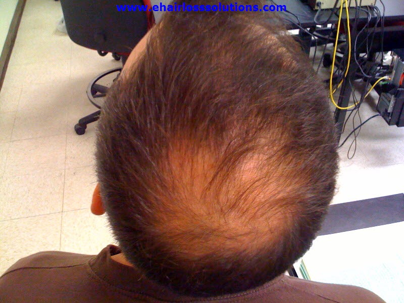 the best ways to stop hair loss in men