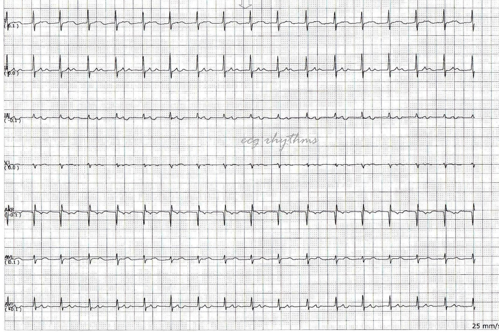 ECG Rhythms: ECG Practice