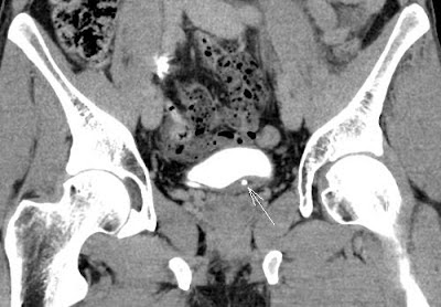 Forniceal rupture caused by juxtavesical ureterolithiasis