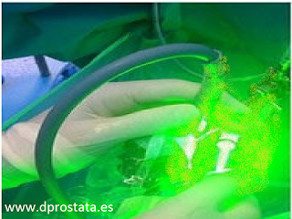 Cirugia de la prostata