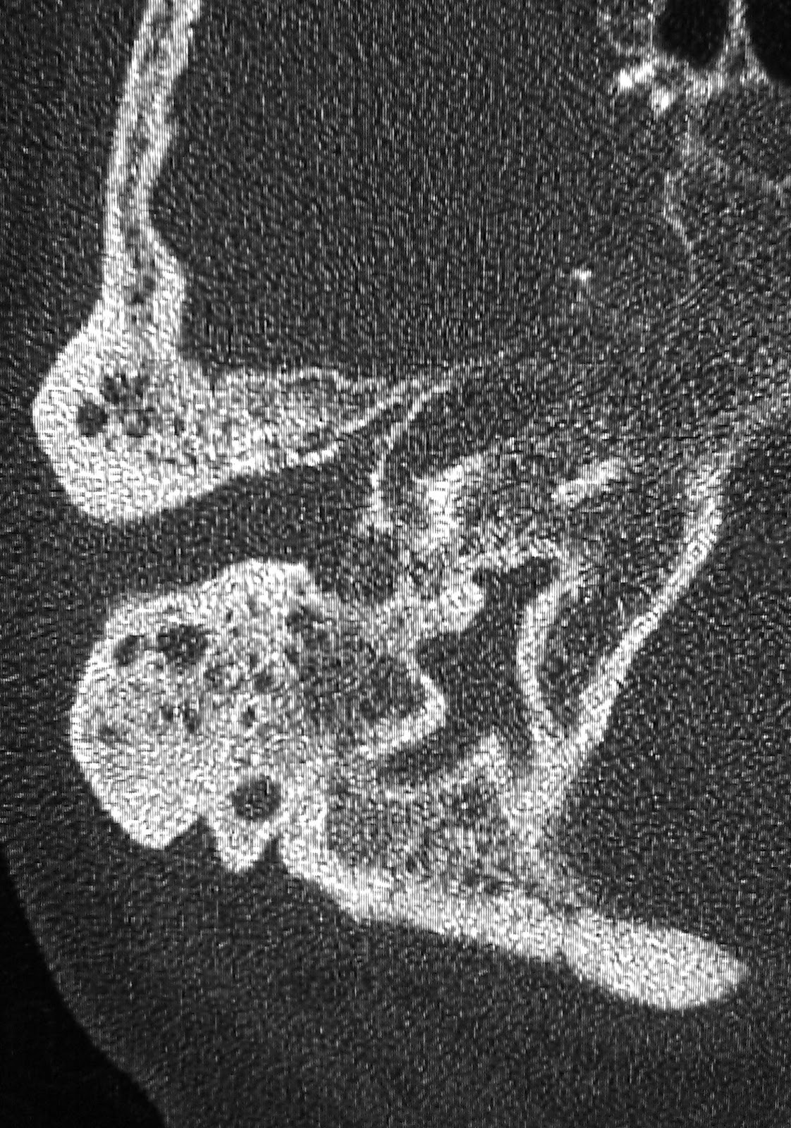 Learning Head And Neck Radiology Case 189 Malignant Otitis Externa