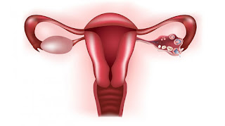 Tumori ovarici