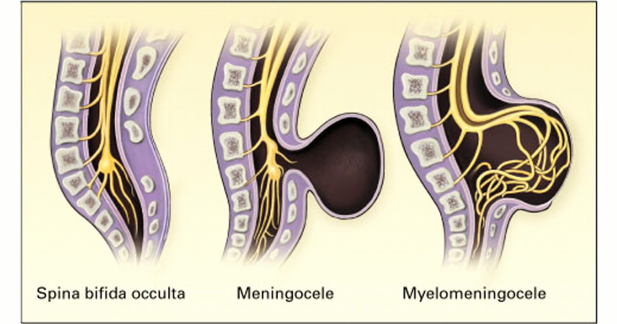 Kinesiology & Sport Review Rehabilitation Spina Bifida