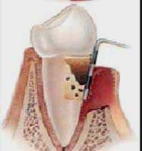 <Img src ="Dibujo-sondaje-periodontal.jpg" width = "188" height "200" border = "0" alt = "Medición o medida de una bolsa periodontal .">