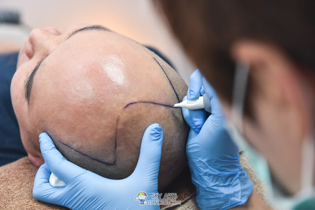 Lay down and relax during the Scalp Micro-pigmentation (SMP) treatment
