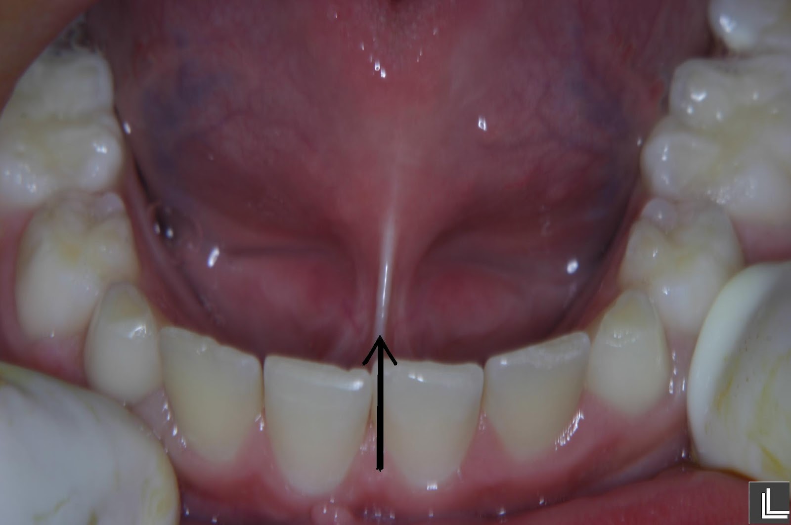 Freio lingual; Frênulo da Língua