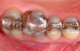 Trám răng có đau không và có biến chứng gì không?