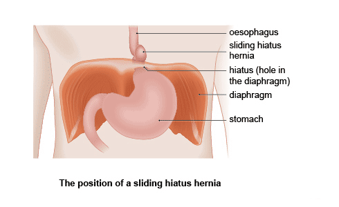 Hiatus Hernia Info: Organic Fixes & Cures to get a Hiatus ... gall bladder body diagram 