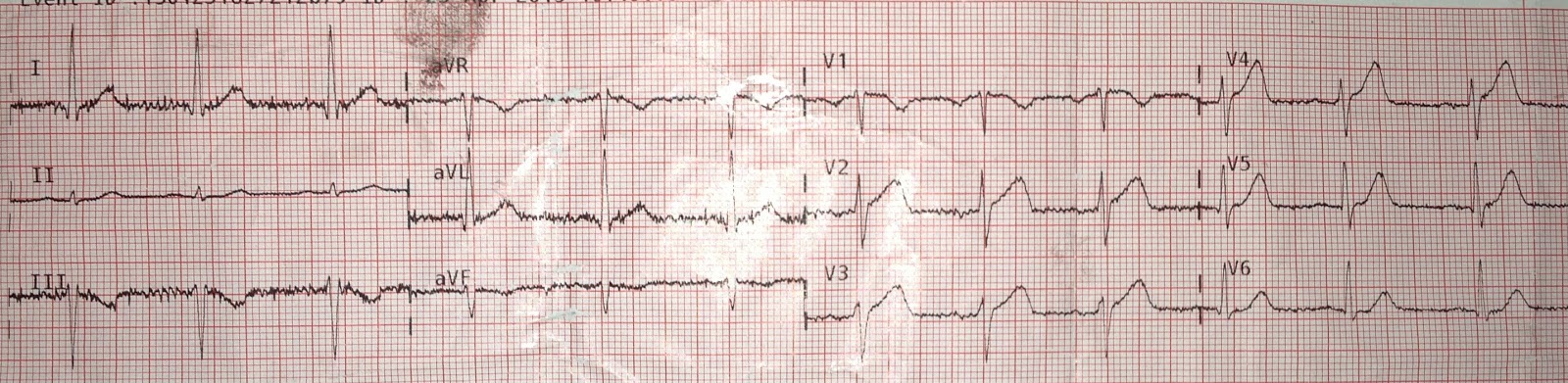 Dr. Smith's ECG Blog: STEMI Seen Best in PVC, Diagnosed by Medic