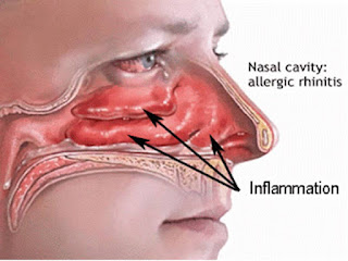  Allergic Rhinitis, ஒவ்வாமை, அலர்ஜி, Ovvamai