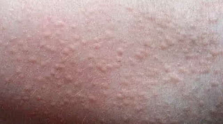 A sweat rash is also linked with stress and anxiety rash images