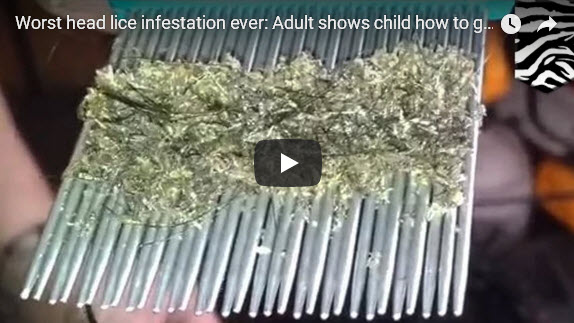 lice head worst ever infestation