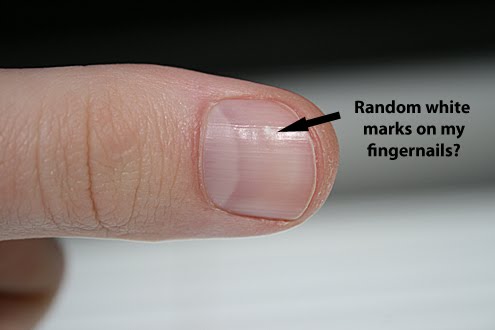 ridges and white spots fingernails