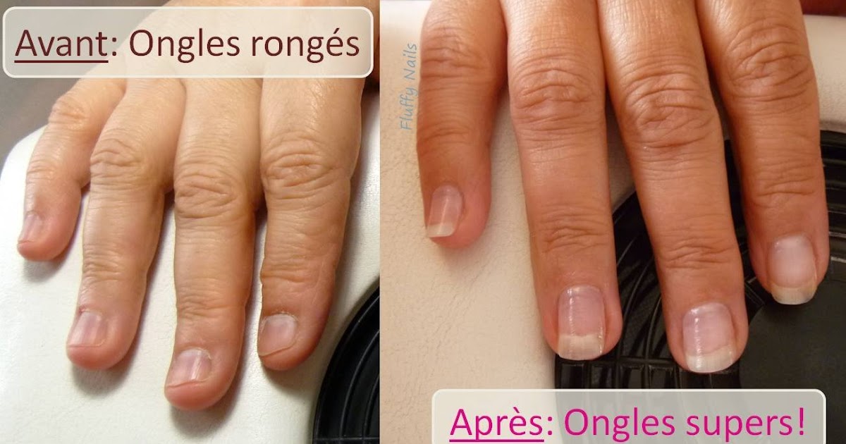 Rever De Perdre Ses Ongles Fluffy Nails: Comment arrêter de se ronger les ongles grâce aux faux