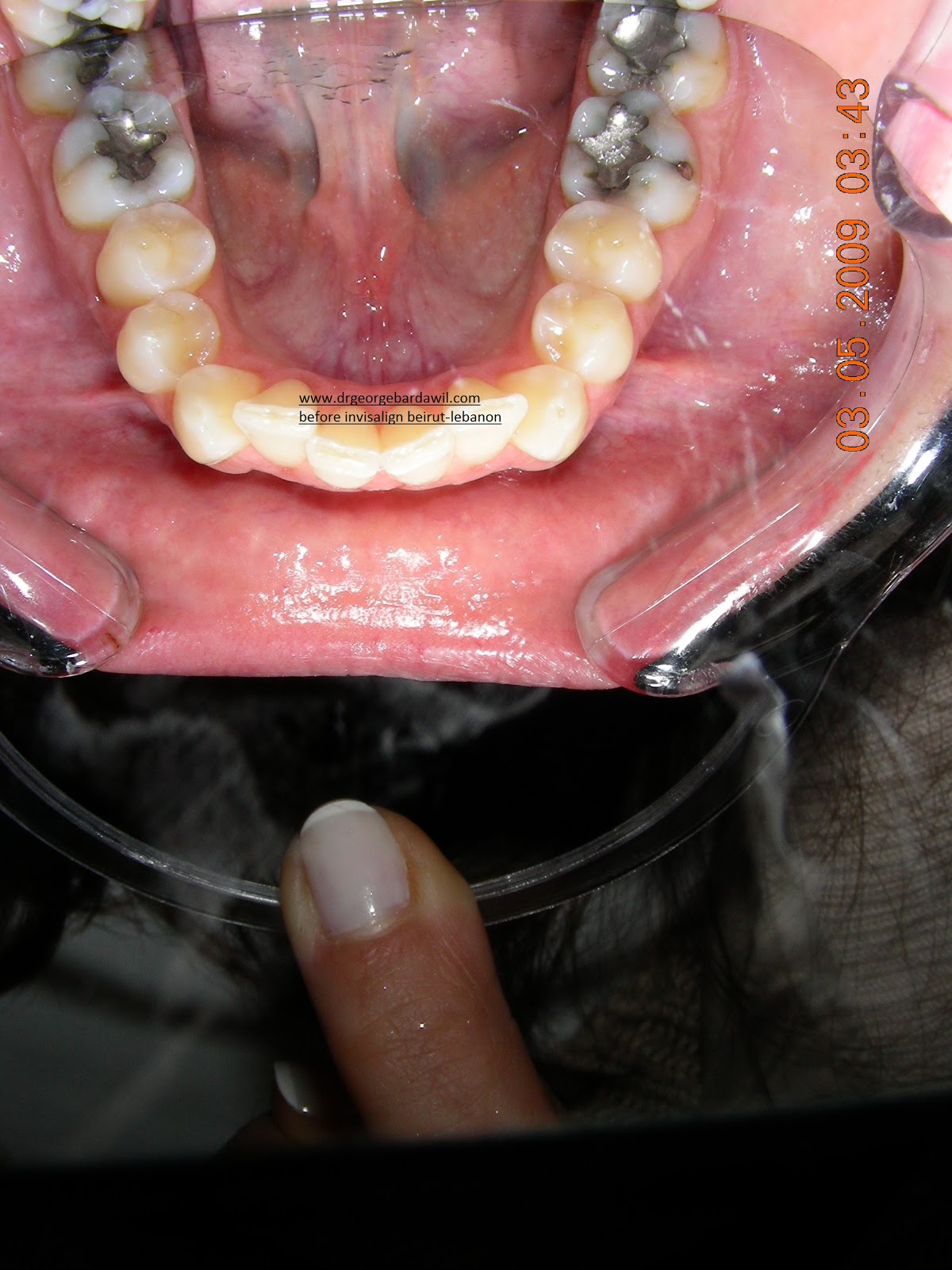 E. BardawilOrthodontistInvisalign Diamond level