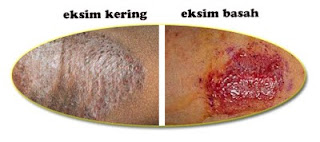 Jual Obat Eksim De Nature Di Sulawesi Selatan (SULSEL) Jual Obat Eksim De Nature Di Sulawesi Selatan (SULSEL)