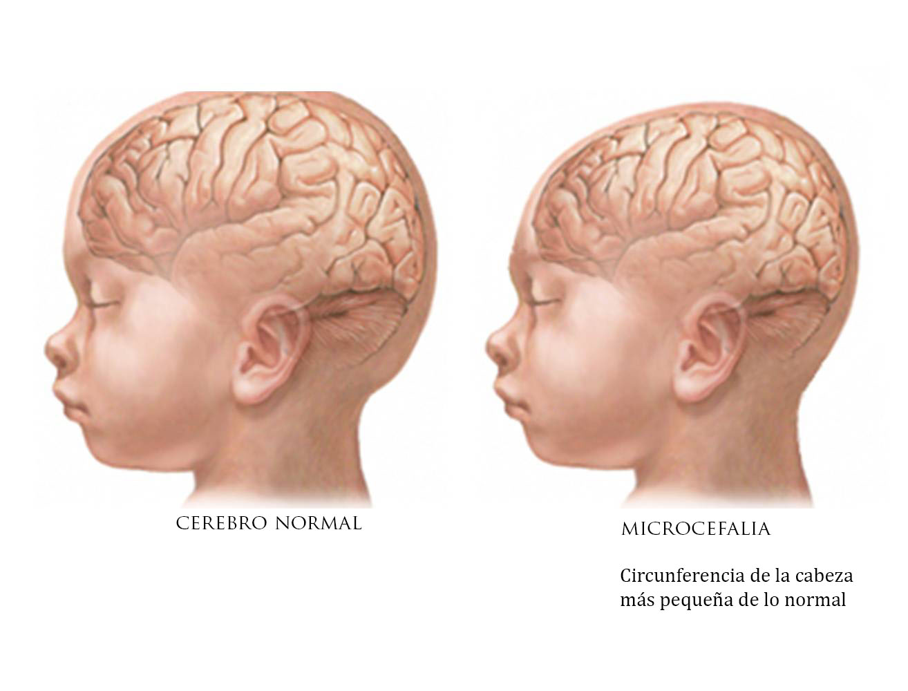 Мозг новорожденного масса. Микроцефалия гидроцефалия. Микроцефалия неврология. Олигофрения микроцефалия.