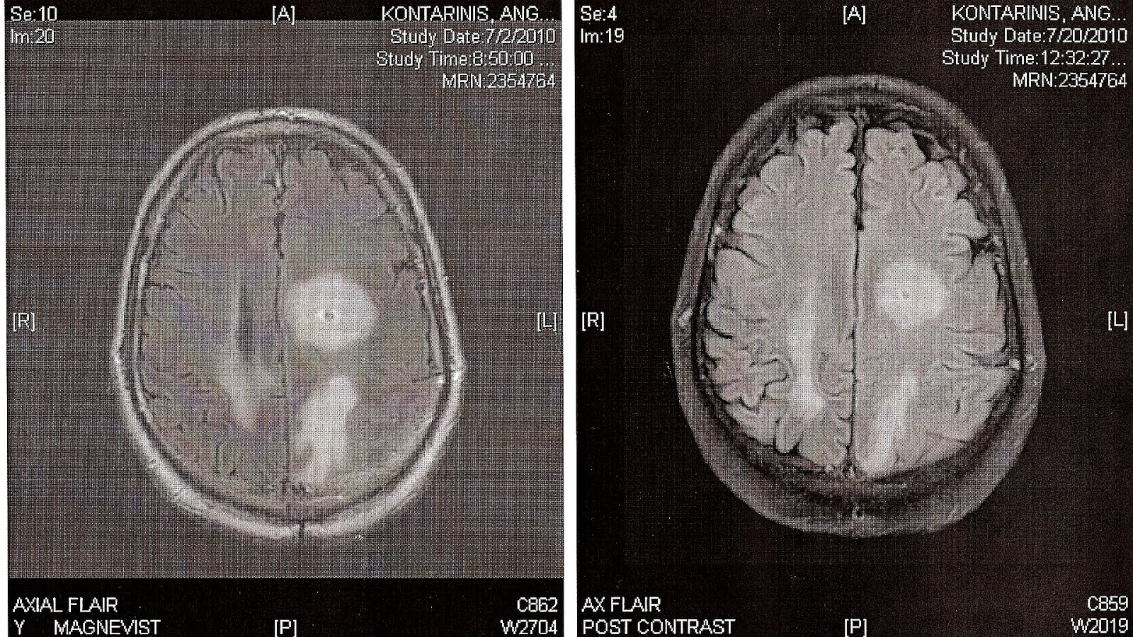 Side Effects Of Mri Effect Choices