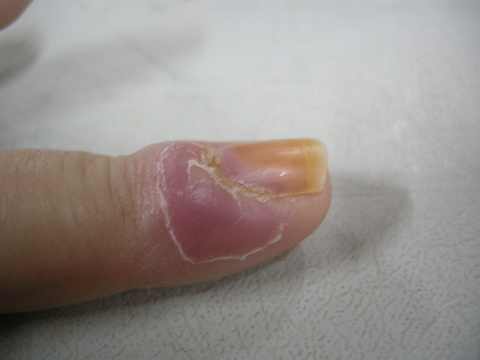 Paronychia (nail infection ) - WebMD Boots