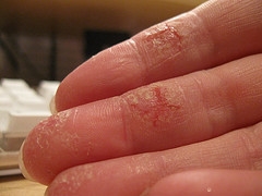 skin cracked hands dry symptomatic relief cut twitter thursday august