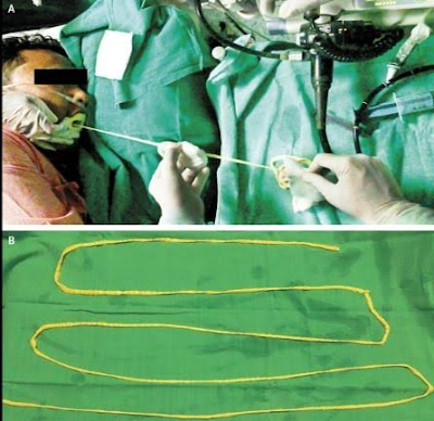 2 Doctors in India remove 6-foot tapeworm through man's mouth