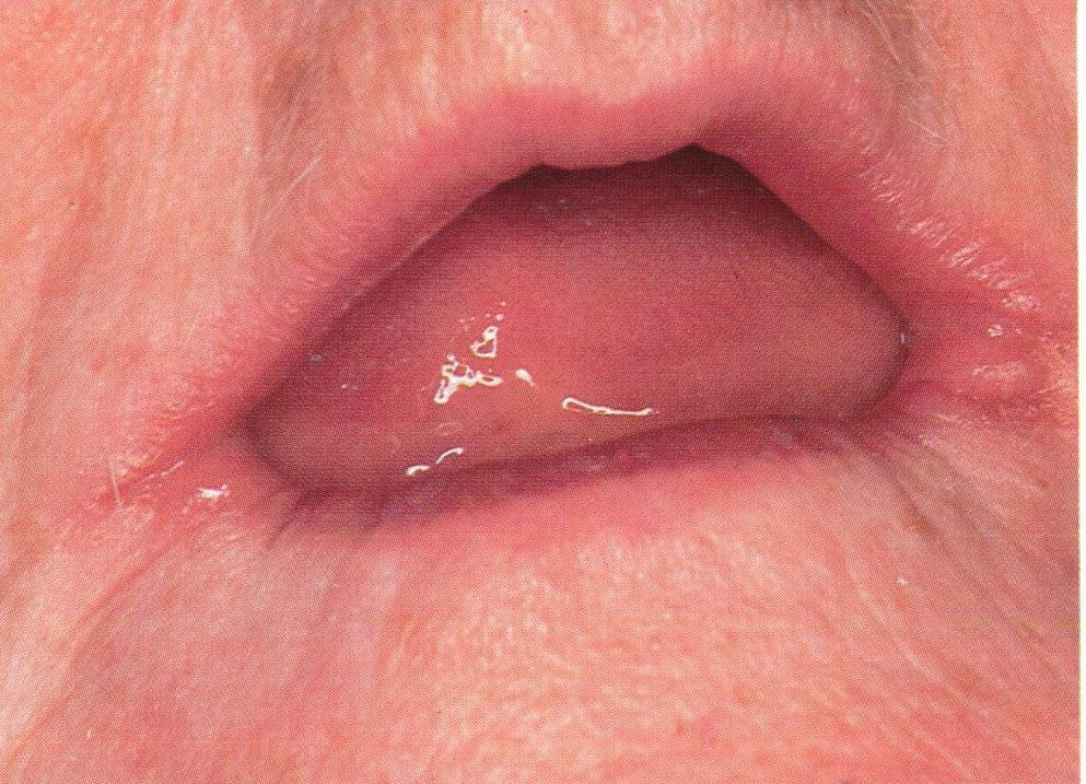 Lip lesion - Dermatology - MedHelp