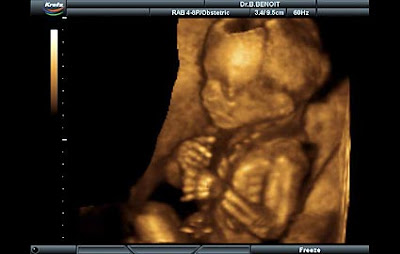 17 haftalık gebelik görüntüsü