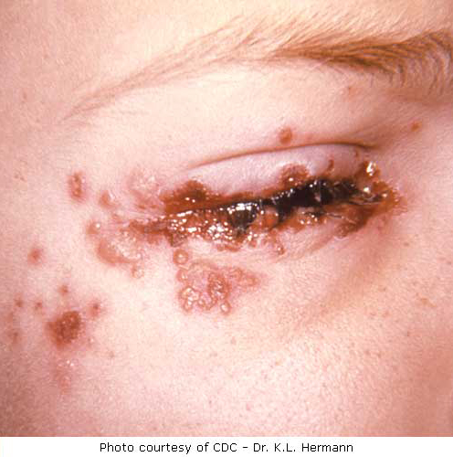 Herpes simplex (koortslip, genitale herpes) (patientenfolder)