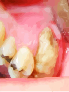 Maxillary tuberosity
