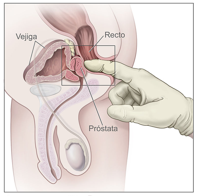 examen de próstata sin tacto