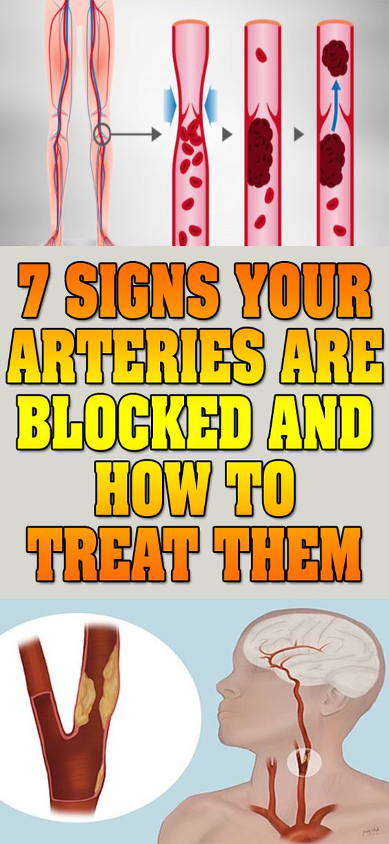 7 Signs Your Arteries Are Blocked And How To Treat Them Fitness Fiesta