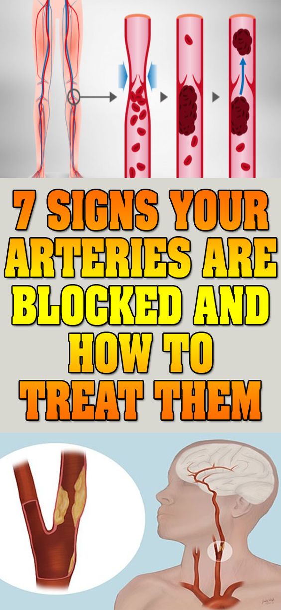 7 SIGNS YOUR ARTERIES ARE BLOCKED AND HOW TO TREAT THEM Fitness Fiesta
