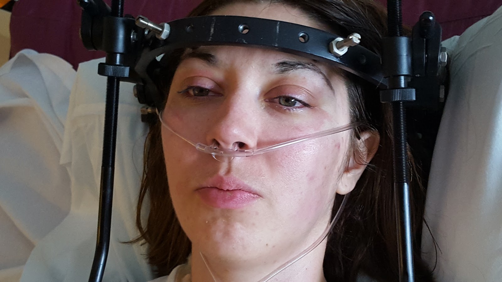 The Halo Diaries First 3 Days After Neck Fusion