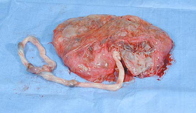 Battledore Placenta - Definition, Complications, Pictures, Causes, Pathology