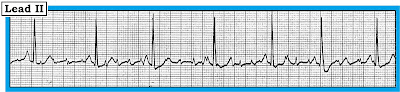 ecg artifact meaning ecg artifact meaning