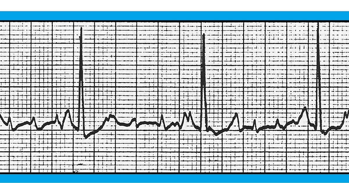ECG Interpretation: ECG Blog #139 (Atrial Flutter – AV Block – Artifact ...