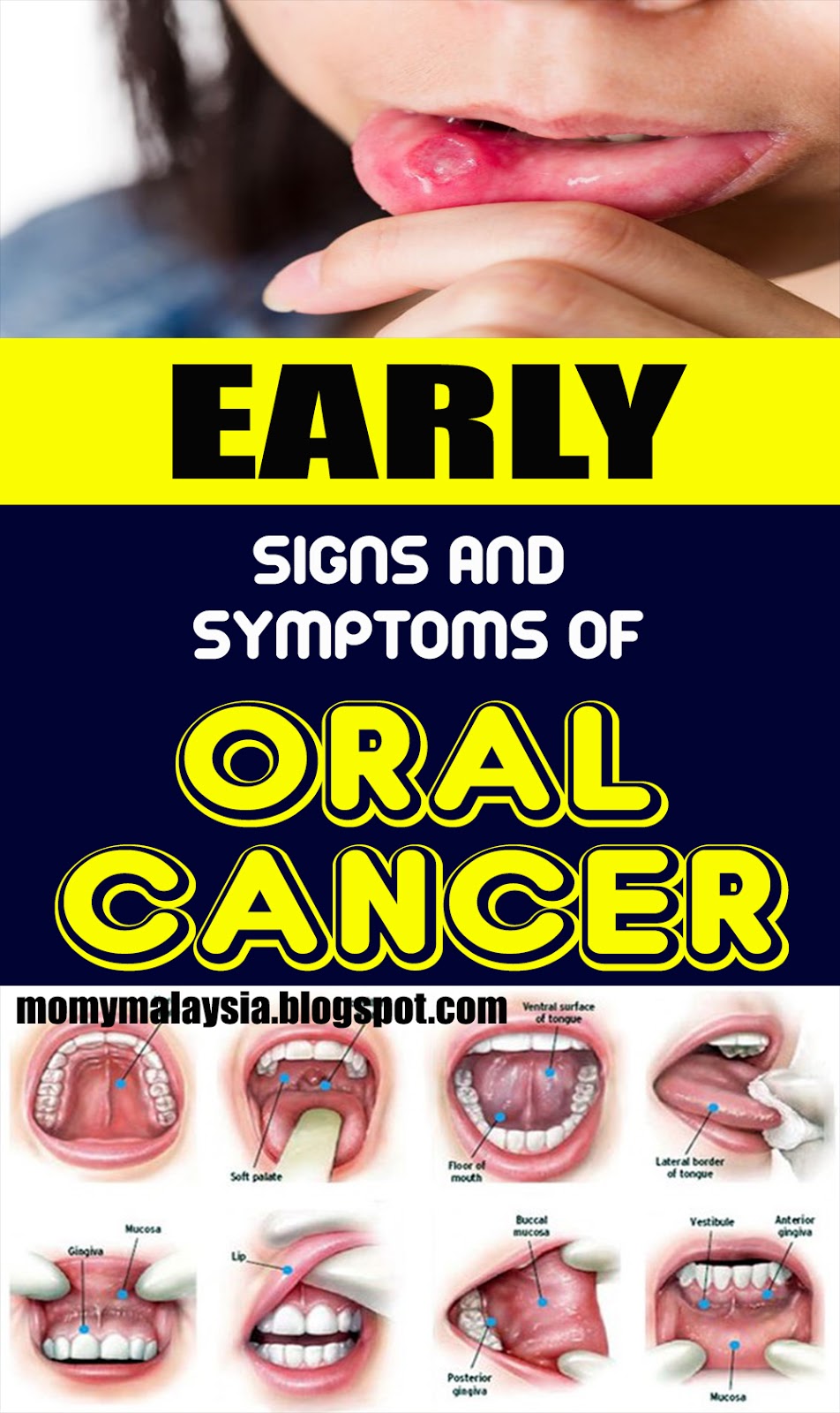 Mouth Cancer Early Warning Signs