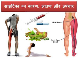 sciatica-symptoms-treatment-in-hindi