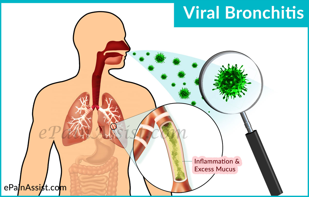Viral Bronchitis Causes