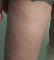Mild cellulite on the leg