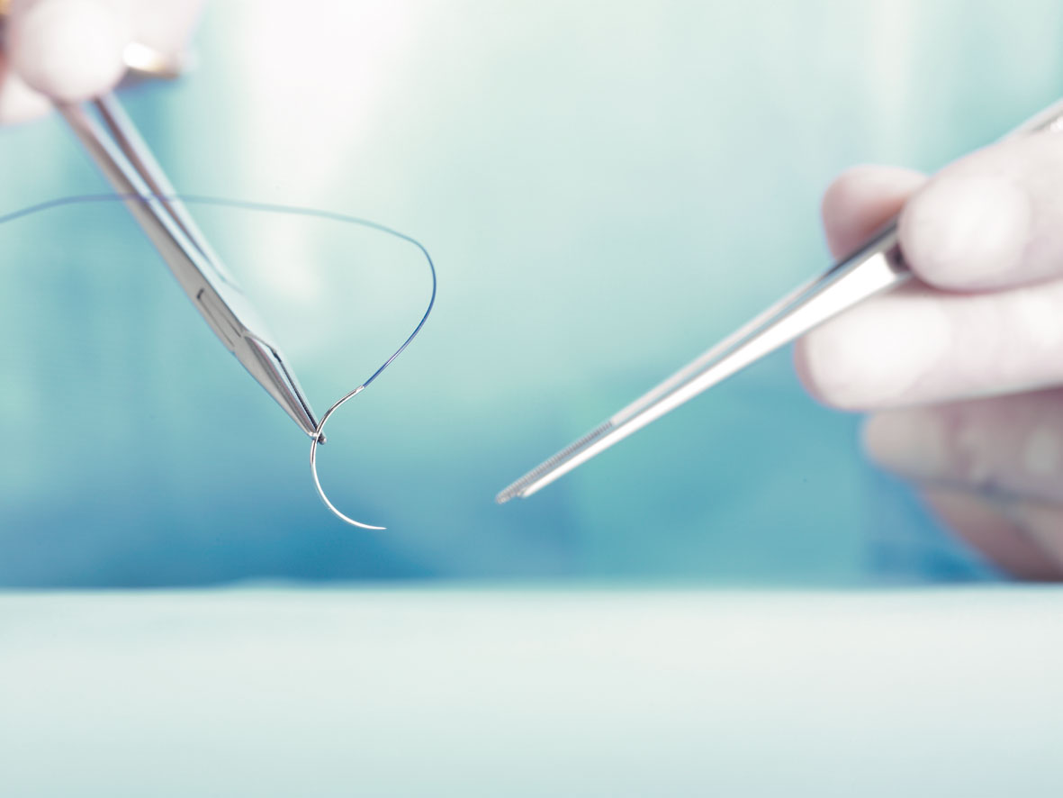 Ob/Gyn Updated Sutures are better than staples in third or highorder
