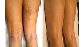 que causa las varices en las piernas